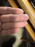 Almost amputated fingers.jpeg