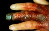 M1650185-Close-up_of_gangrene_of_infected_fingers-SPL.jpg